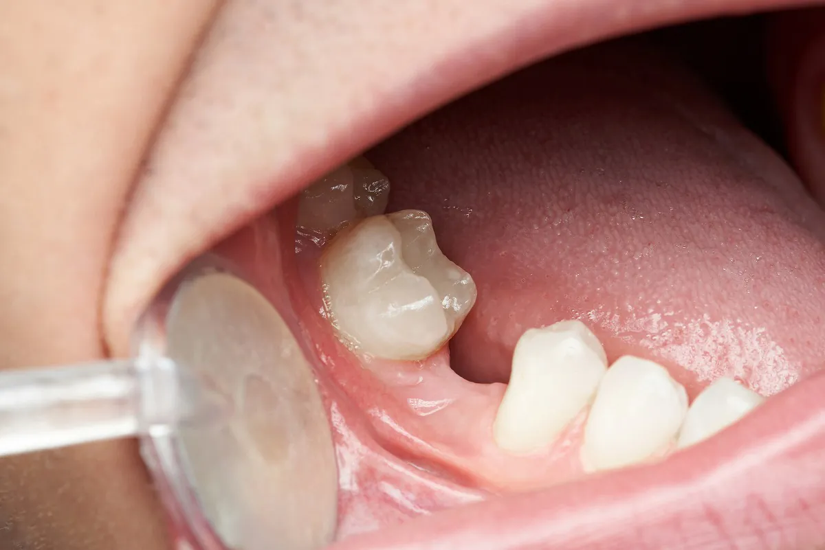 歯がない状態をそのまま放置する危険性