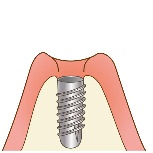 一次処置：インプラント埋入