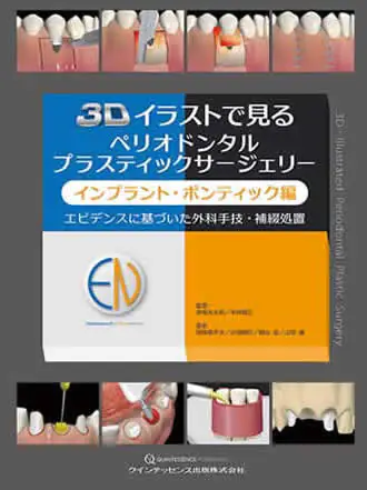 3Dイラストで見るペリオドンタルプラスティックサージェリー インプラント・ポンティック編エビデンスに基づいた外科手技・補綴処置